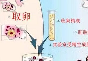 女性有染色体罗氏易位在昌邑市做试管养囊成功率高吗？试管移植后需要保胎吗！